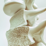 Obesit Sarcopenica e Osteoporosi: Progressi della Ricerca e Sfide Attuali